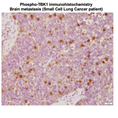 Phospho-TBK1 immunohistochemistry in a brain metastasis of a Small Cell Lung Cancer patient.