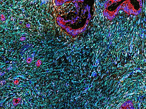 Multicolor microscopy image of human pancreatic cancer. Red areas depict cancer cells and cyan marks the desmoplastic tumor microenvironment, which is enriched in fibroblastic cells positive for 3D-adhesions (evident in cyan areas marked by lighter yellow/white colors).  Note the vast areas covered by the fibrous (cyan) desmoplasia in comparison to the modest amounts of cancer cells (red).Image credit: Neelima Shah and Edna Cukierman.