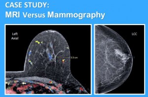 Mammogram Vs. Breast MRI: What's the Difference? - Intercoastal Medical  Group