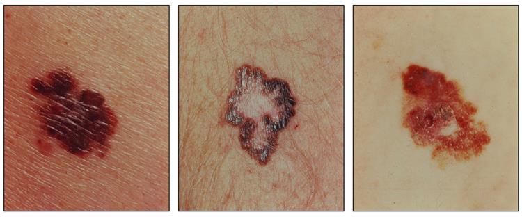 Melanomas with characteristic asymmetry, border irregularity, color variation, and large diameter. (courtesy of the NIH)