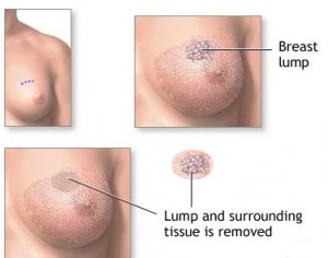 A collage of drawings showing a breast lump, where the incision would be in a breast conserving surgery, and the lump and surrounding tissue removed.