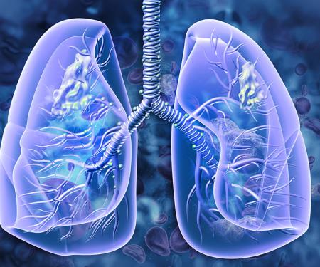 Systemic Therapy Options for Lung Cancer