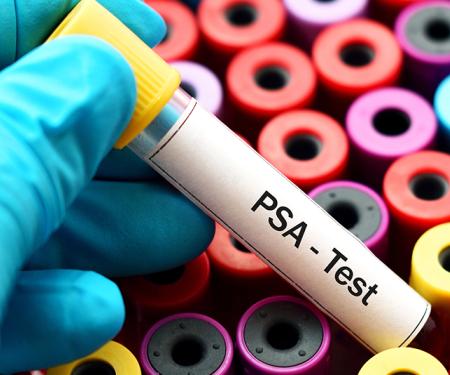 A photograph of dozens of upright vials with different colored lids, a gloved hand above it holds one that reads, "PSA - Test."