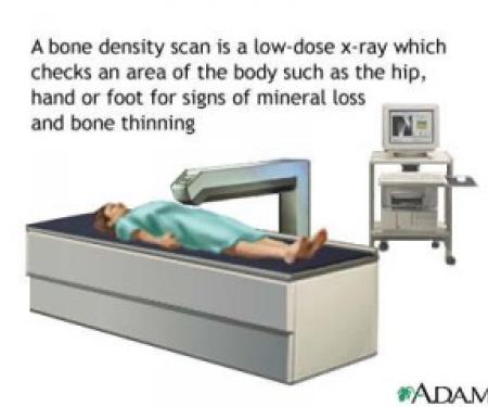 A drawing of a person lying under a bone density scanner, a low dose x-ray that checks for mineral loss or bone thinning.