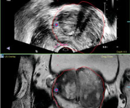 Two black and white MRI images stacked on top of each other, highlighting a problematic area.